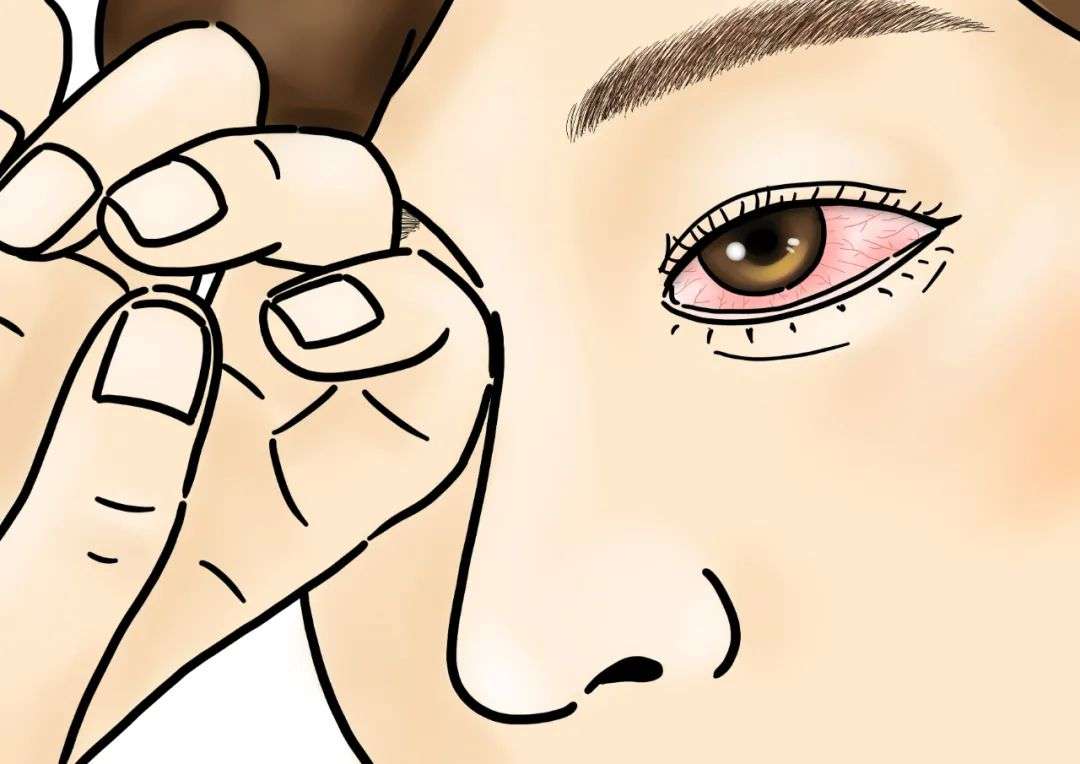 過敏 性 結膜炎​