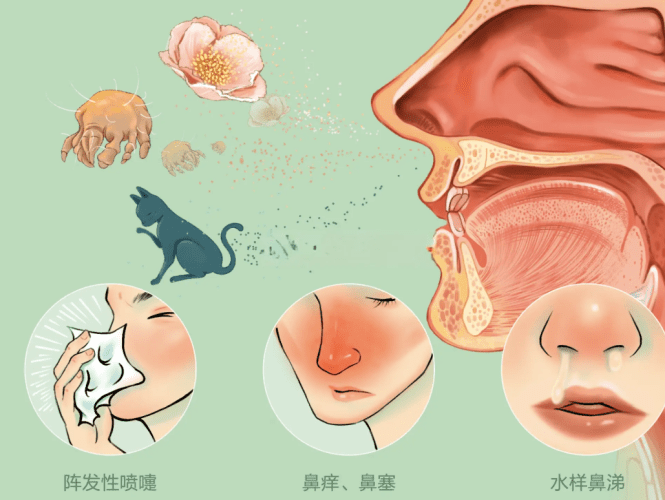 鼻子 過敏 根治