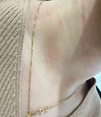 脖子過敏症狀 脖子過敏症狀