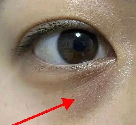 鼻子過敏黑眼圈 鼻子過敏黑眼圈