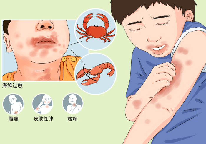 海鮮 過敏 多久 會 好