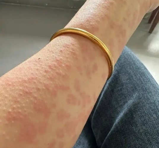 藥物過敏怎麼辦 藥物過敏怎麼辦