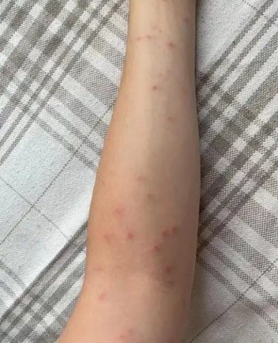 熱過敏原因 熱過敏原因