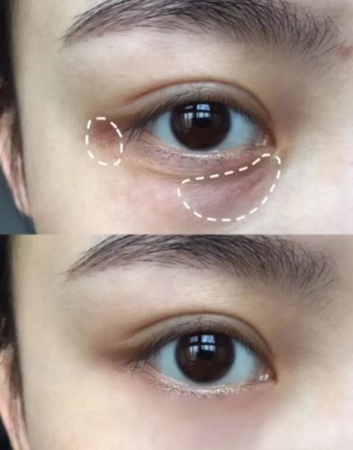 過敏黑眼圈治療 過敏黑眼圈治療