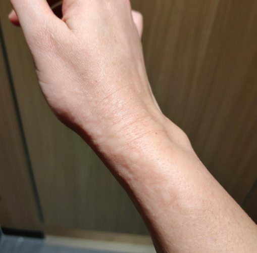 貓毛過敏治療 貓毛過敏治療