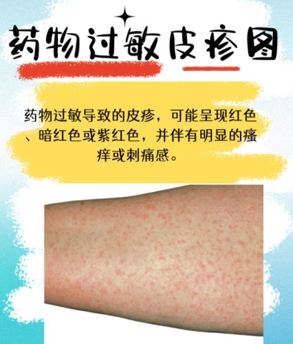 藥物過敏的症狀 藥物過敏的症狀