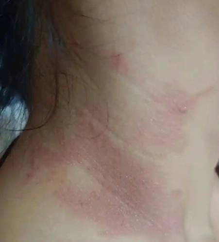 脖子過敏 脖子過敏