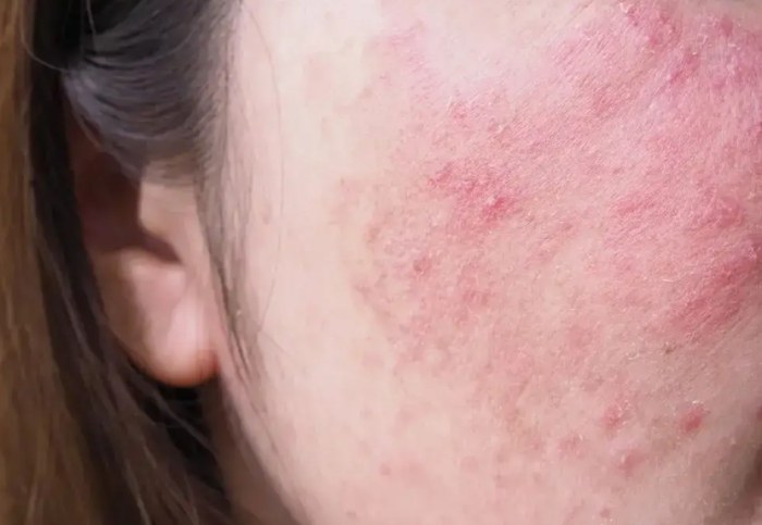 皮膚過敏該看什麼科