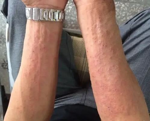 皮膚過敏種類