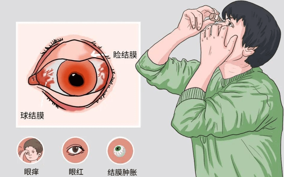 過敏性結膜炎 過敏性結膜炎