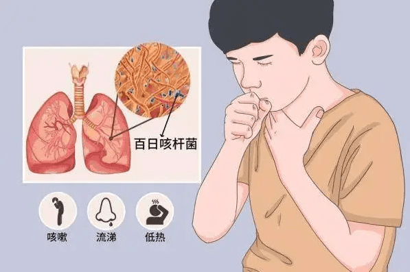 過敏咳嗽症狀 過敏咳嗽症狀