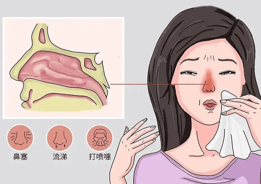 改善鼻子過敏的食物 改善鼻子過敏的食物