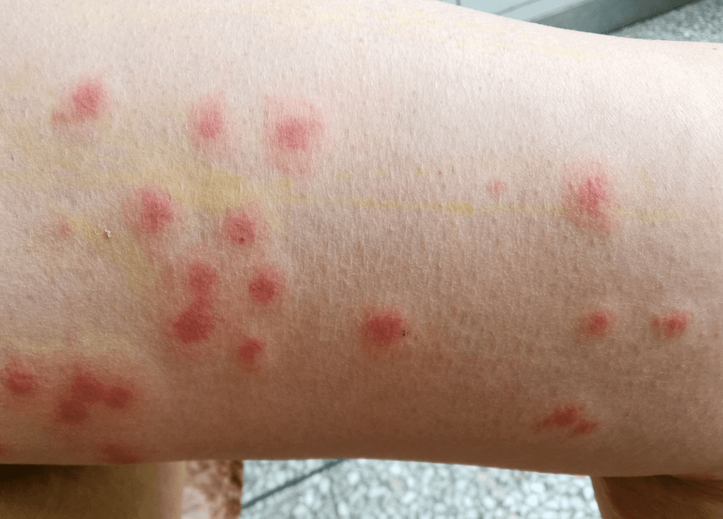 蚊子過敏體質 蚊子過敏體質