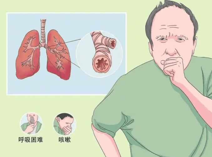 氣管過敏症狀 氣管過敏症狀
