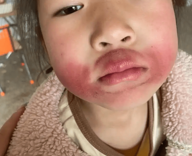 嘴唇過敏怎麼辦
