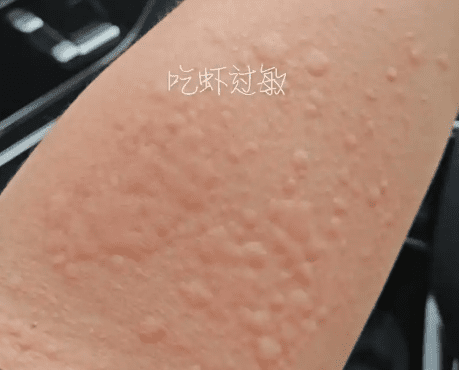 蝦過敏怎麼辦
