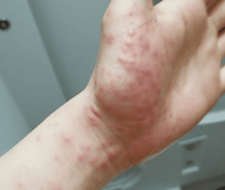 蝦過敏症狀