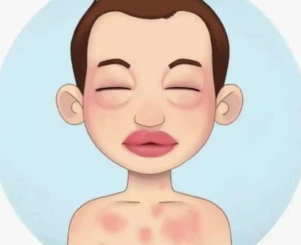 什麼是過敏性休克