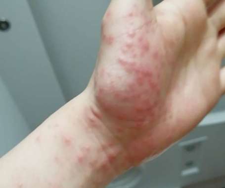 蝦子過敏症狀 蝦子過敏症狀