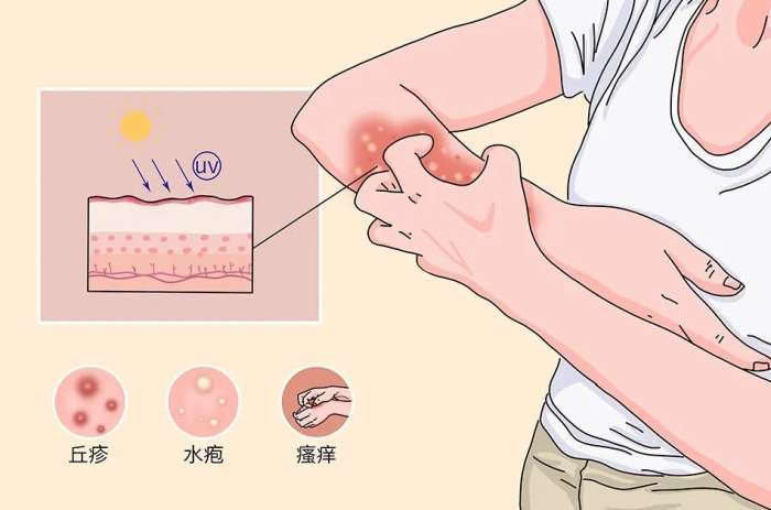 吃藥會過敏嗎 吃藥會過敏嗎