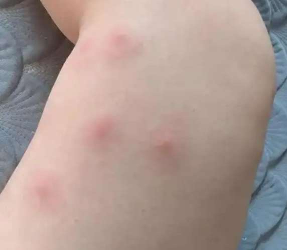 被蚊子叮多久會消 被蚊子叮多久會消